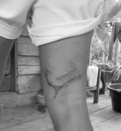 Diterkam Buaya Saat Memancing, Warga Marok Kecil Selamat Meski Alami Luka Gigitan